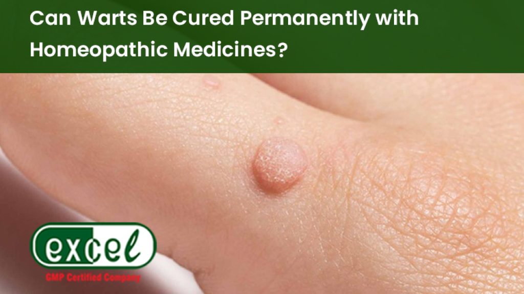 Can Warts Be Cured Permanently with Homeopathic Medicines?