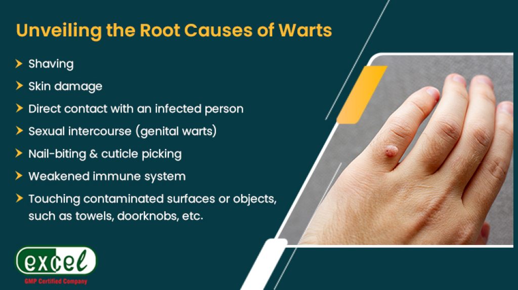 Unveiling the Root Causes of Warts