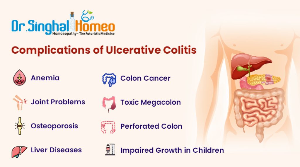 Ulcerative Colitis Treatment in Homeopathy