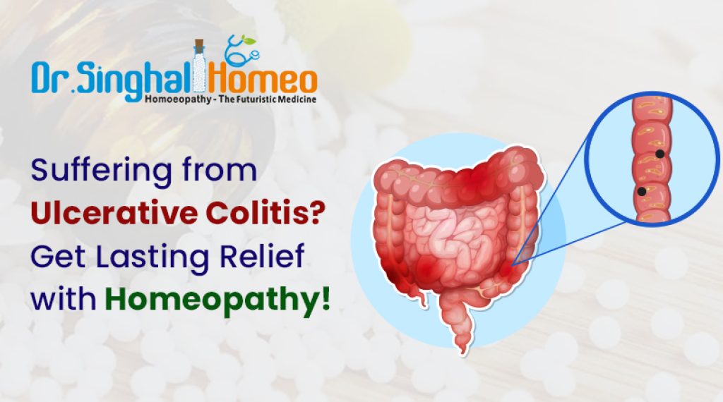 Can Homeopathy Offer Relief for Ulcerative Colitis Sufferers?