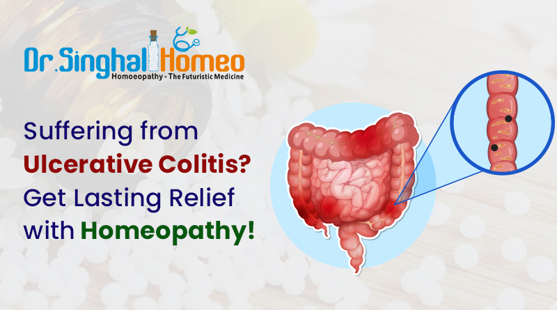 Homeopathic Treatment for Ulcerative Colitis